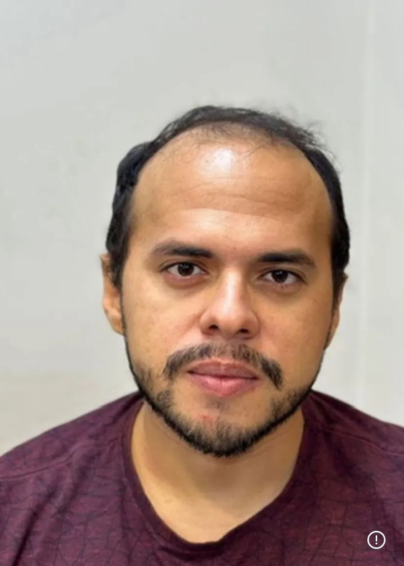 Antes: cabello escaso en la coronilla